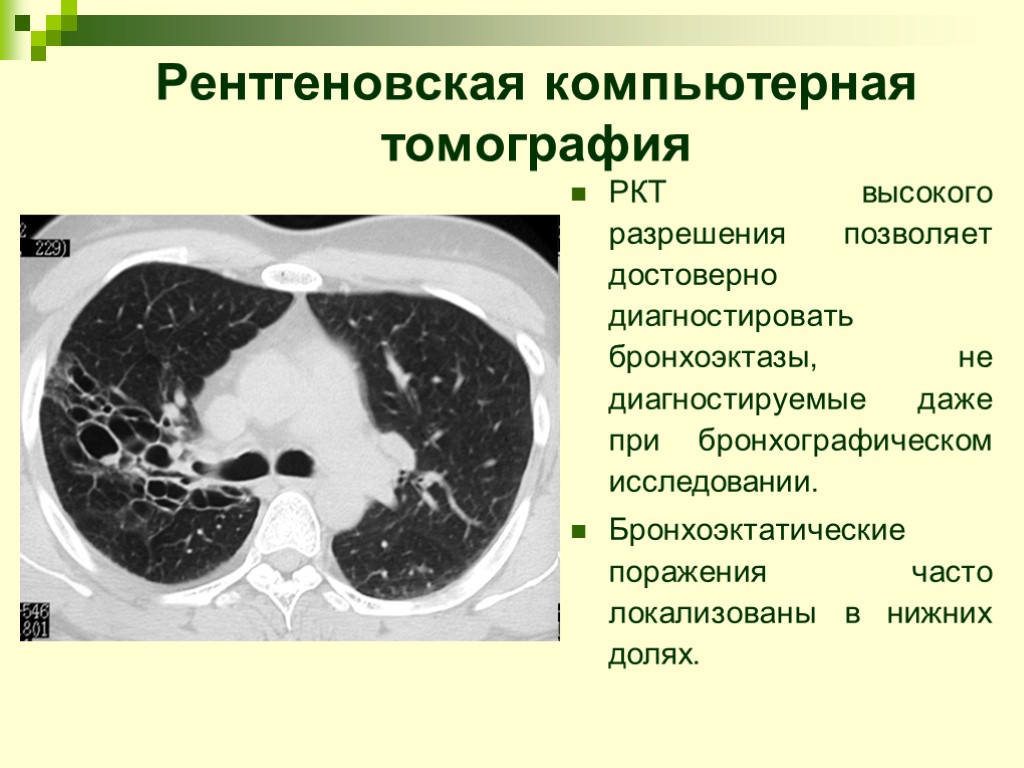 Рентгеновская компьютерная томография РКТ высокого разрешения позволяет достоверно диагностировать бронхоэктазы, не диагностируемые даже при